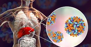 صورة توضيحية لالتهاب الكبد